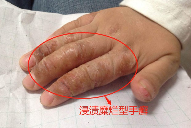 手真菌感染的症状图片
