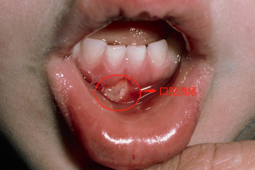 轻度口腔溃疡图片图片