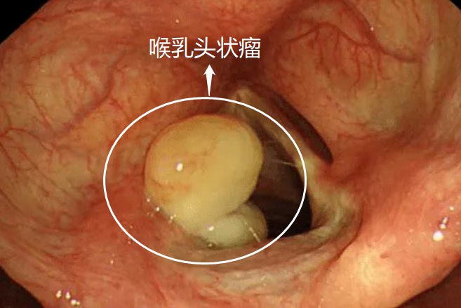 喉乳头状瘤