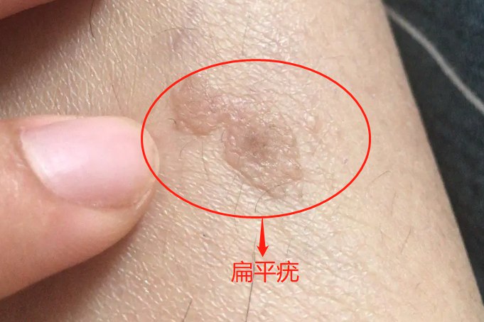 女性扁平疣初期图片
