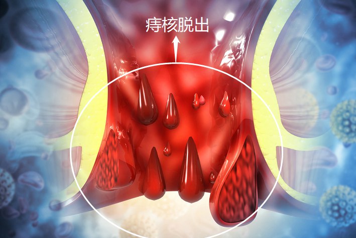 痔核坏死脱落图片图片