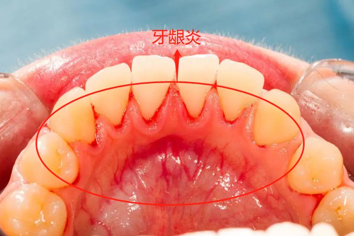 牙龈炎牙龈炎表现为患处红肿,刷牙时有出血的情况,严重者会出现牙龈