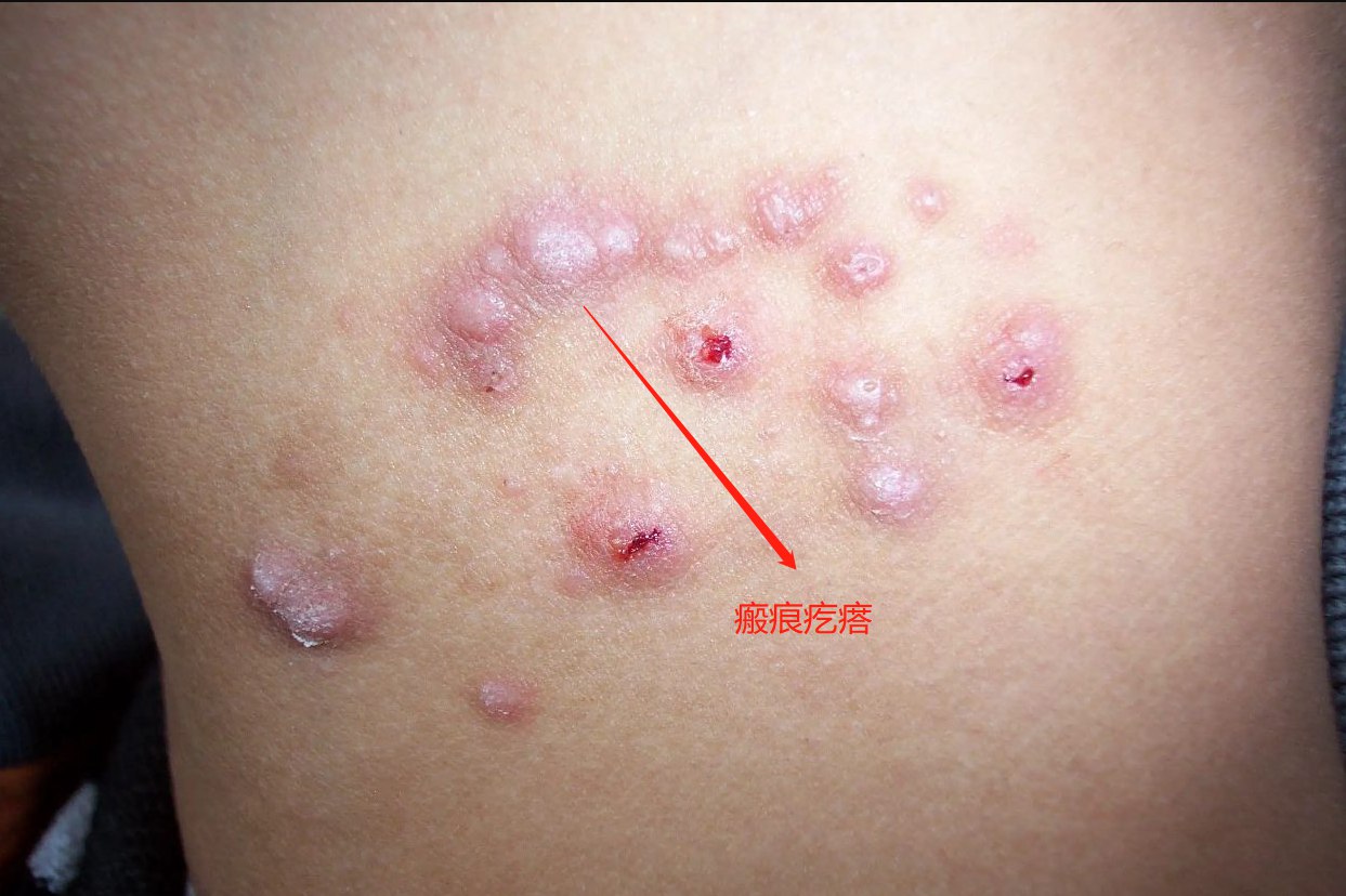 瘢痕疙瘩图片