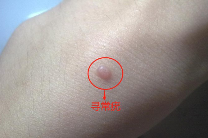 女性寻常疣初期图片