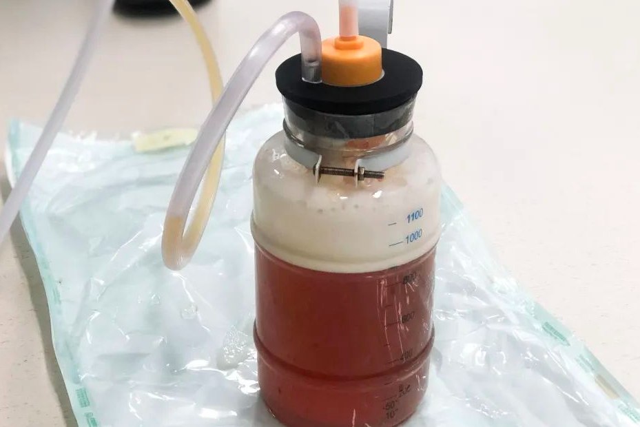 肺积水严重图片