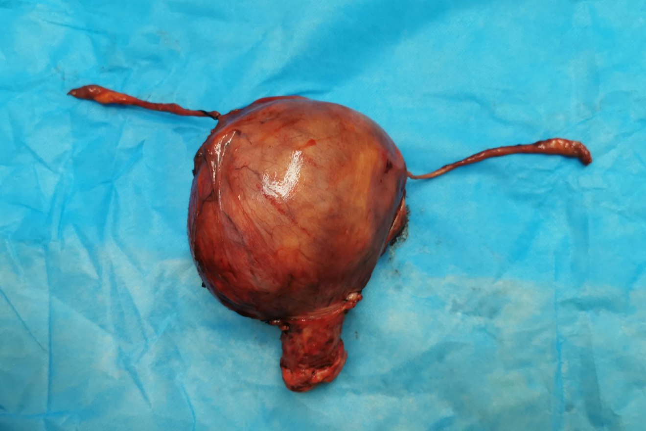 前壁子宫肌瘤图片图片