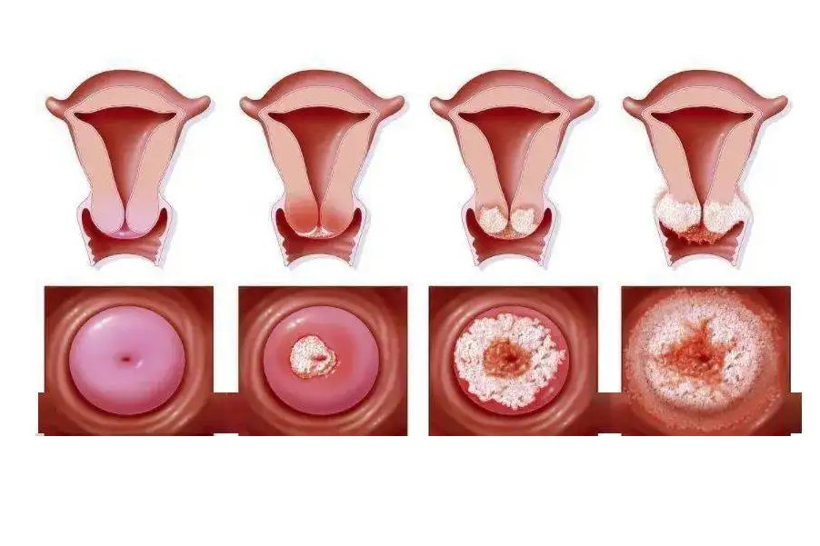 宫颈糜烂对比照片图片
