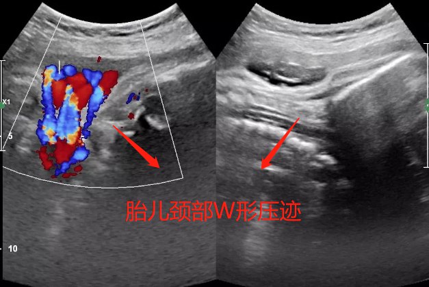 胎儿颈部w型压迹图片图片