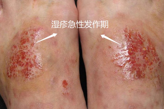 湿疹是一种慢性,炎症性,瘙痒性皮肤病,皮损表现为红斑,红斑的基础上