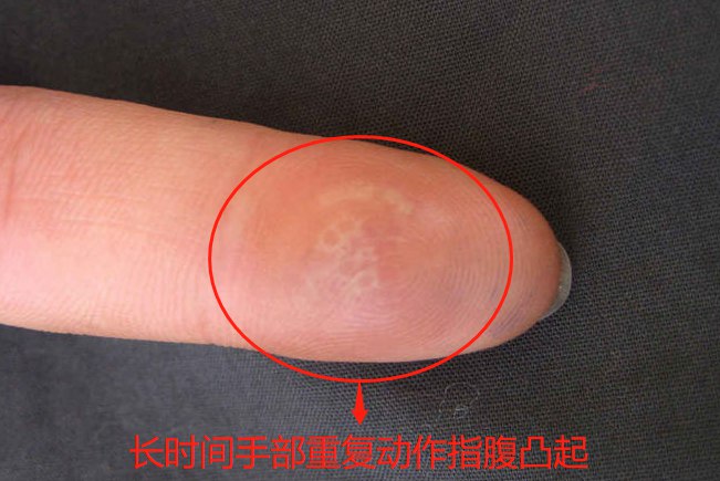 在手指上形成的病理性结节,从而表现为指腹凸起