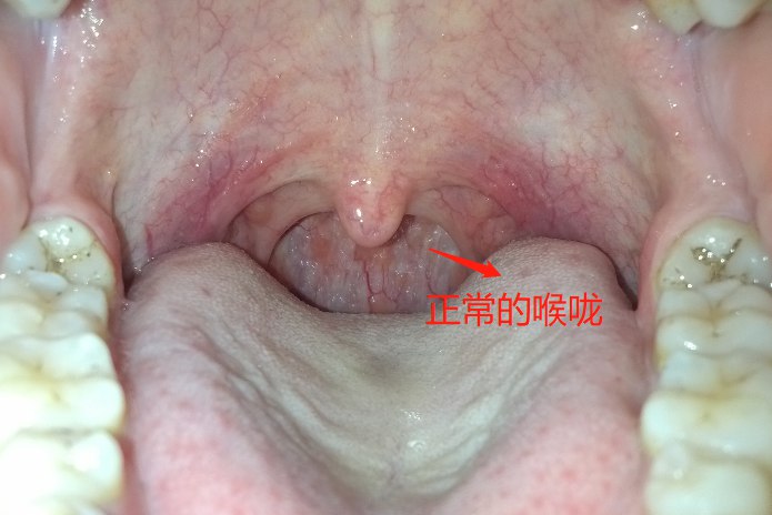 喉咙正常与发炎图片