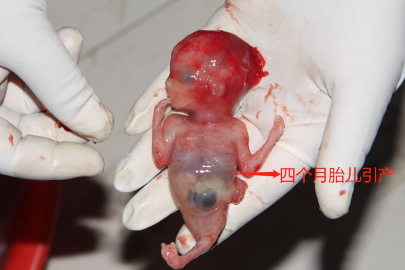 四个月胎儿引产后图片