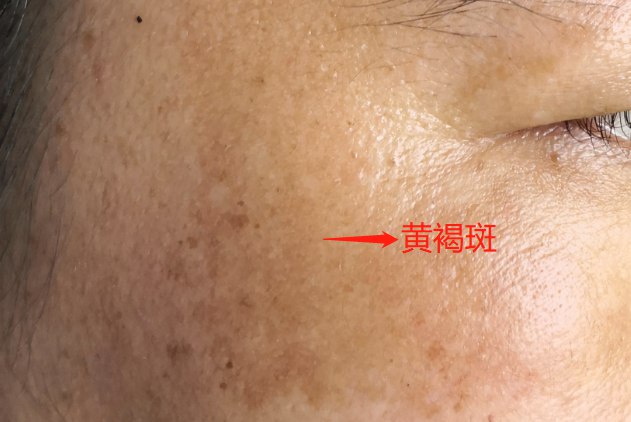 黄褐斑的皮损表现为淡褐色至淡黑色,大小不等,形状不规则的斑疹或斑片