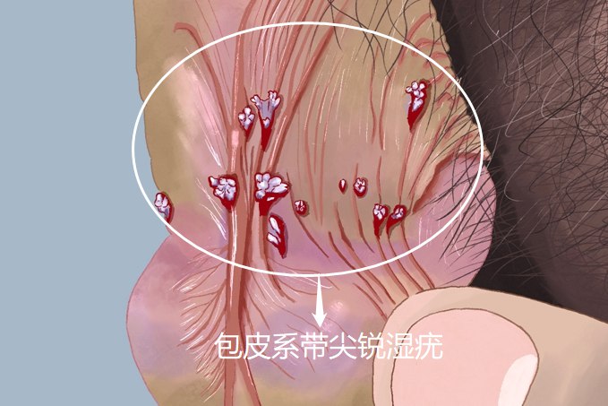 系带长了个肉疙瘩图片图片