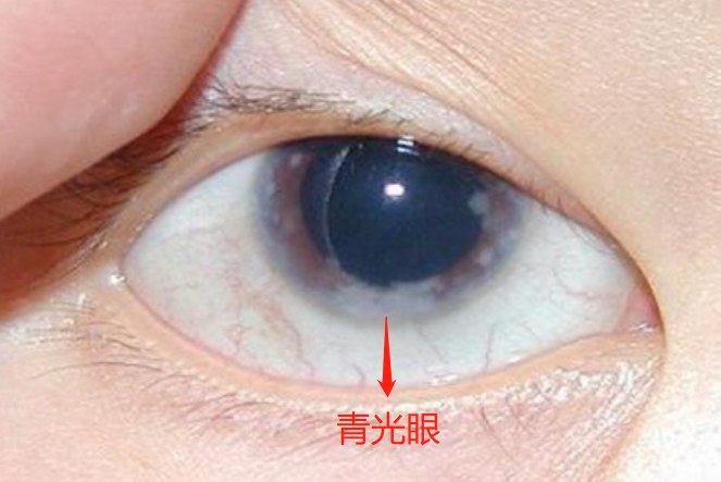 1,青光眼白眼球发青是青光眼最常见的症状之一,这种情况通常发生在