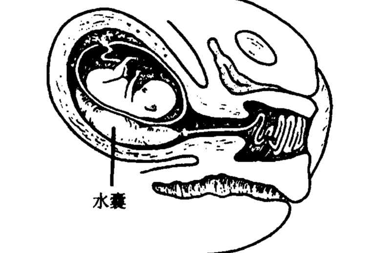 引产水囊图片