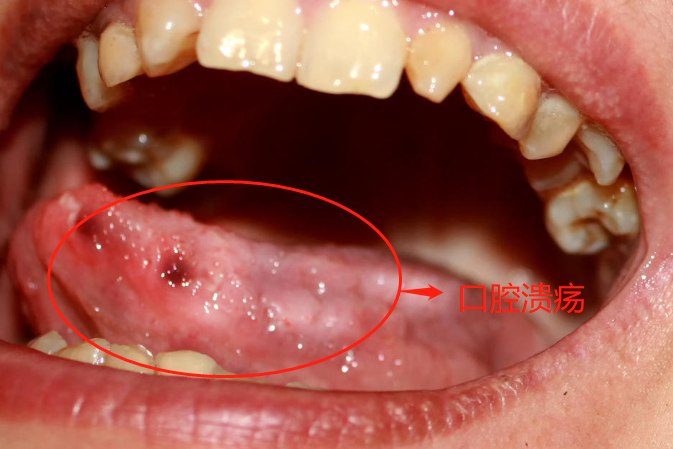舌底口腔溃疡图片