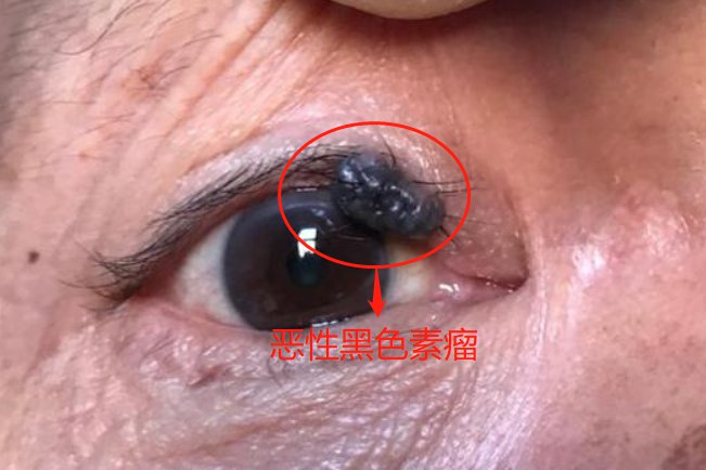 眼角恶性黑色素瘤图片