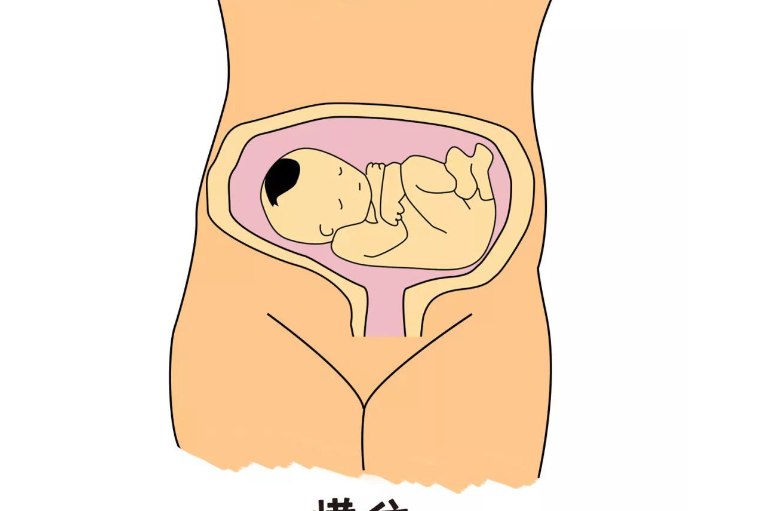 颜面部对着孕妇的背部,胎儿枕部及背部位于孕妇腹壁侧,双手交叉在胸前