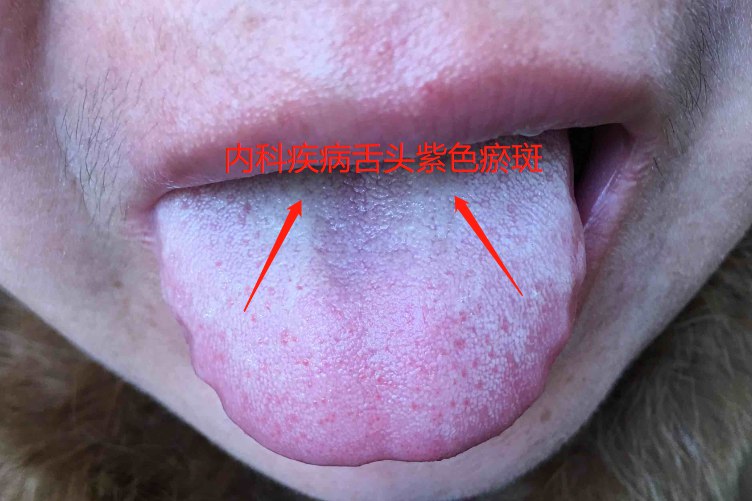 内科疾病舌头紫色瘀斑