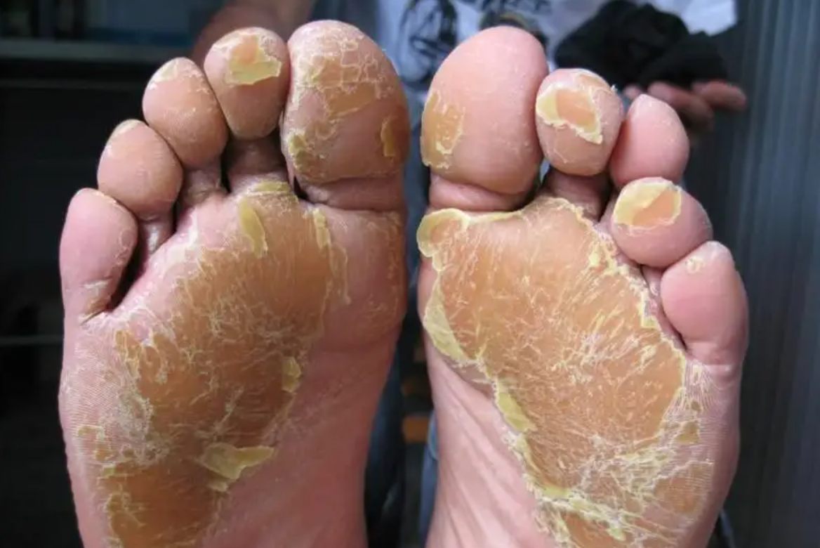 脚底皲裂性湿疹会导致足底皮肤出现皮肤粗糙,干燥,脚板纹理明显加深