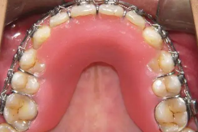 伸长后牙,打开牙齿的咬合面,留出空间让后牙伸长,达到矫正牙齿的效果