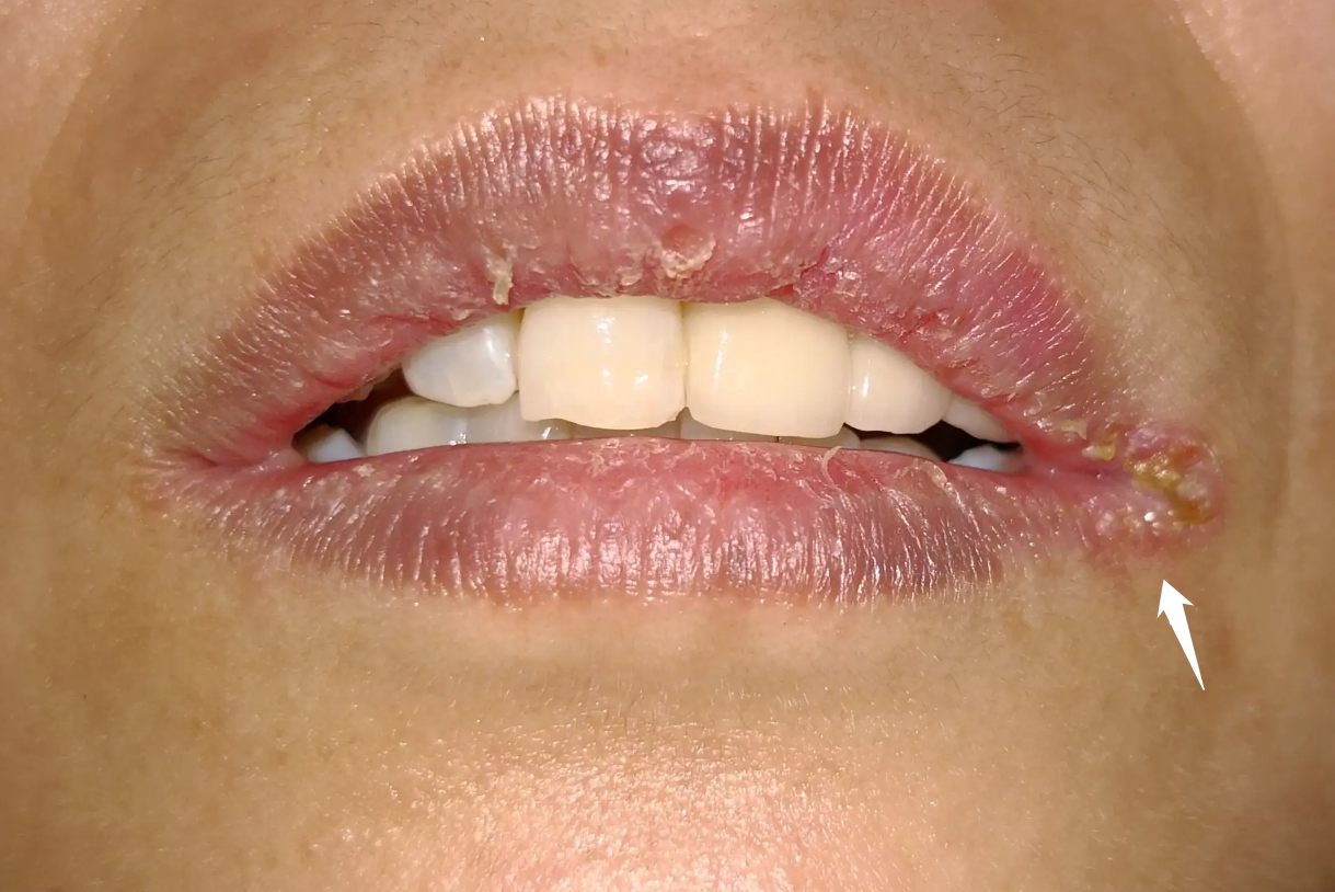 1,口腔念珠菌病口腔念珠菌病又可分为念珠菌性口炎,念珠菌性唇炎以及
