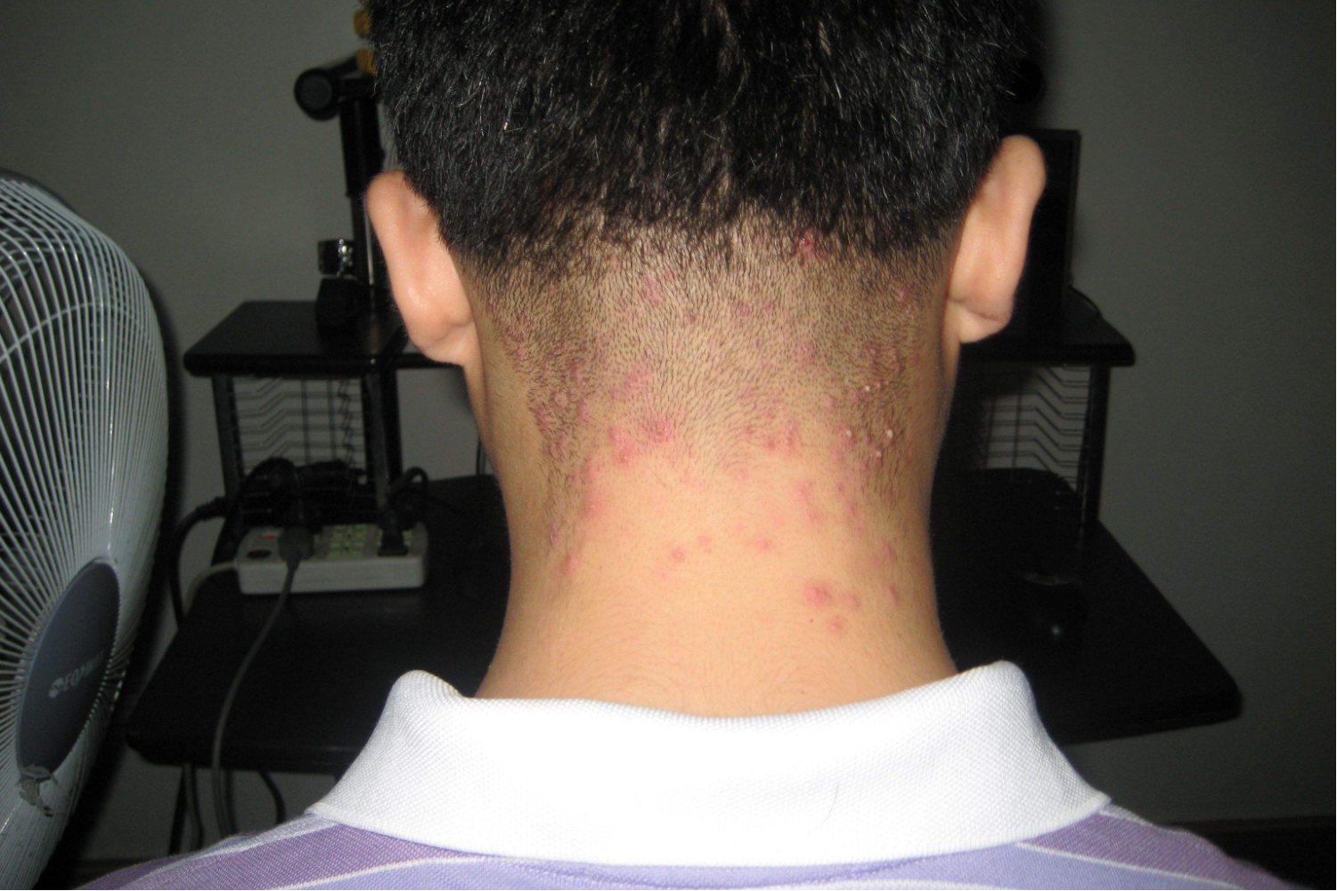 粒形状的异常情况,可表现为头皮处出现小白点,是由于皮脂与油脂组成的