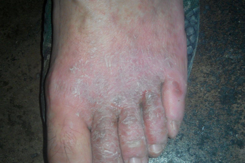 脚过敏性皮炎症状图片图片