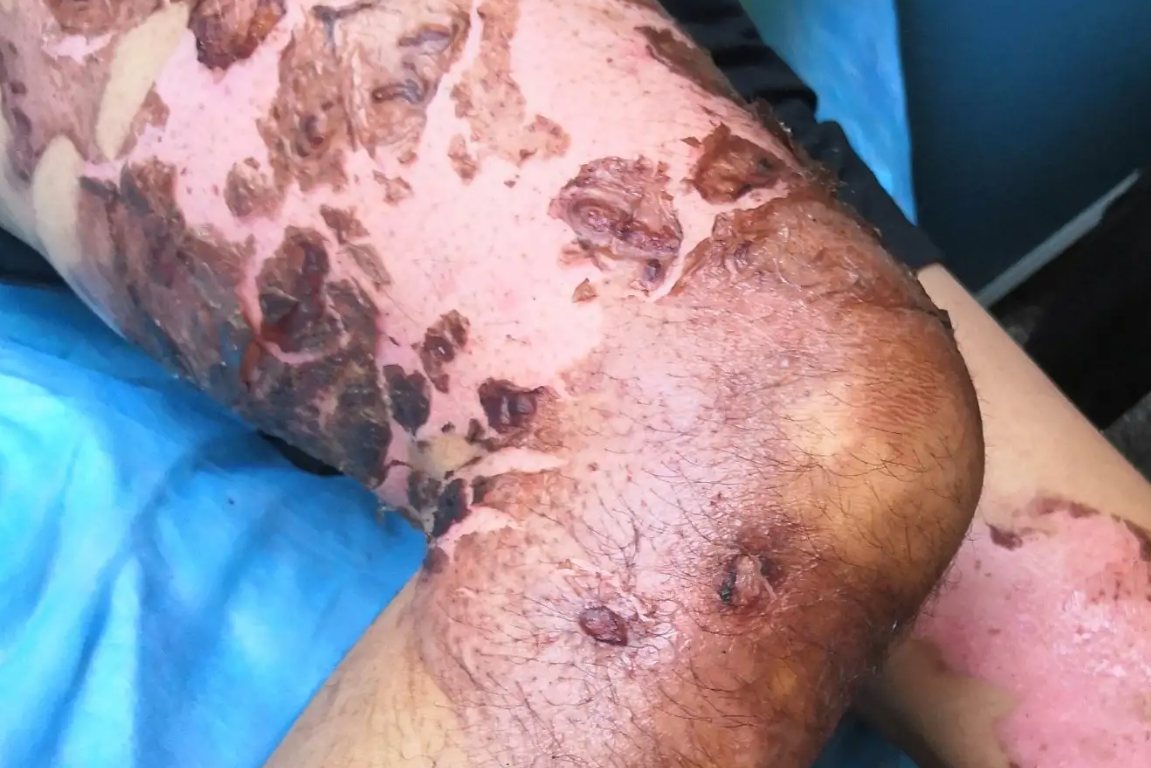 薄薄的痂皮脱落后图片