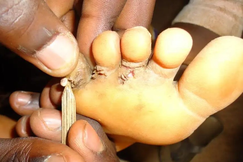 非洲沙蚤脚图片