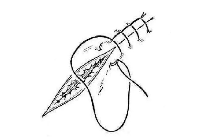 2,單純連續縫合:在第一針縫合後打結,繼而縫合整個創口,結束前的一針