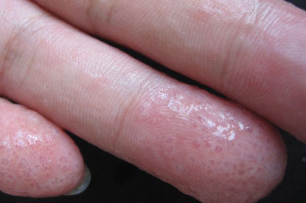 手指汗疱疹 初期图片