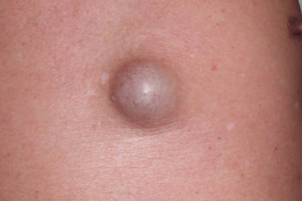 皮脂腺囊肿初期图片