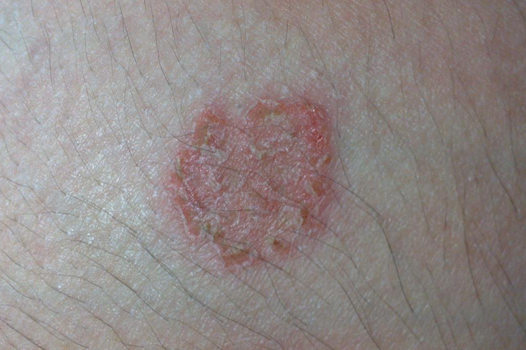 人被兔癣传染的症状图片