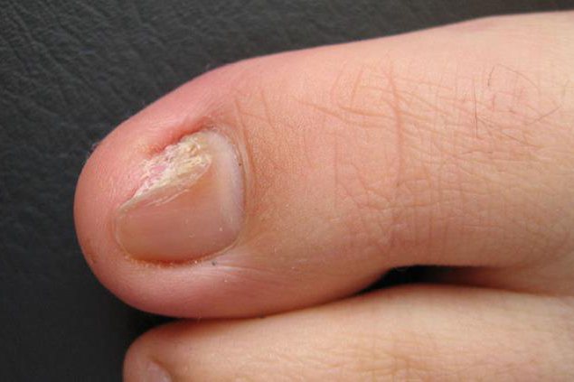 灰指甲有什么症状?图片