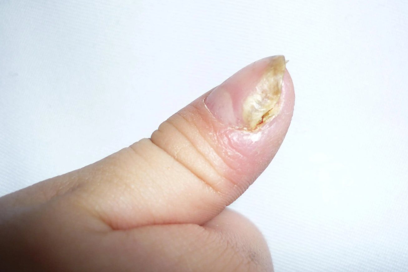 大拇指甲沟炎症状图片图片