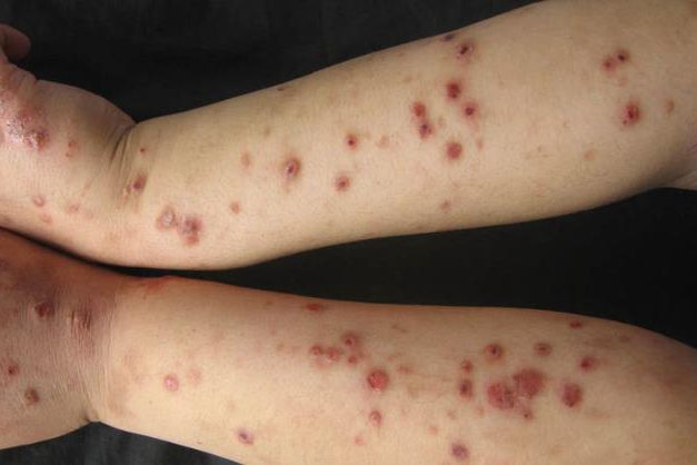 痒疹是什么症状图片