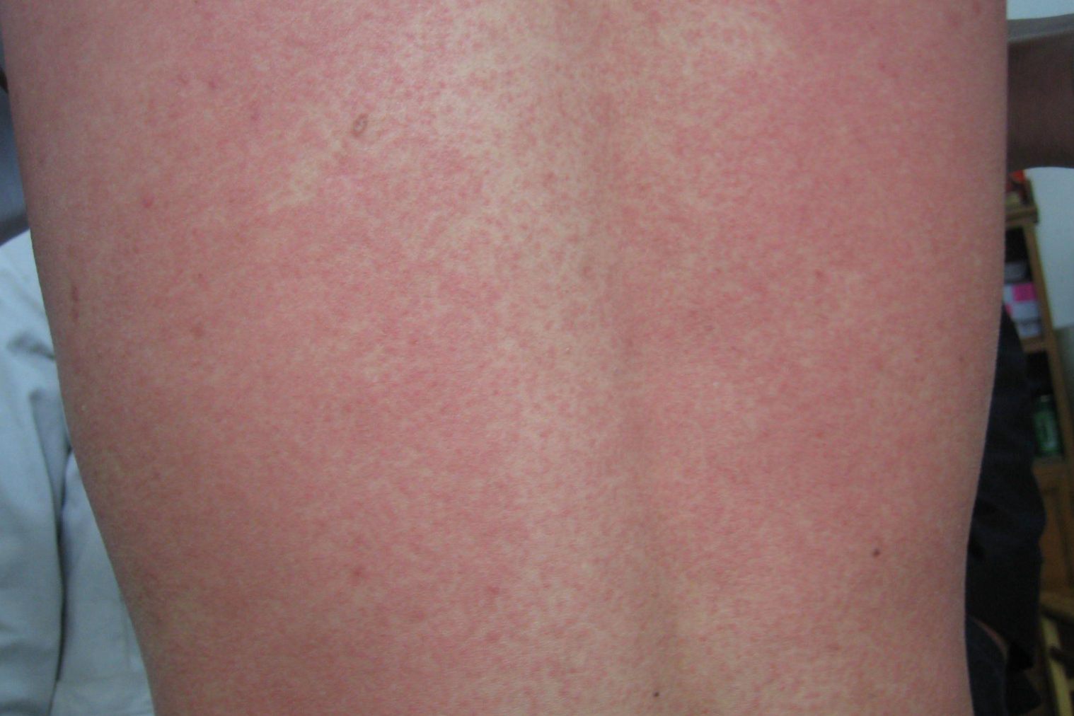 局部皮肤瘙痒等症状,常发生于皮肤的暴露位置,常因皮肤直接接触过敏
