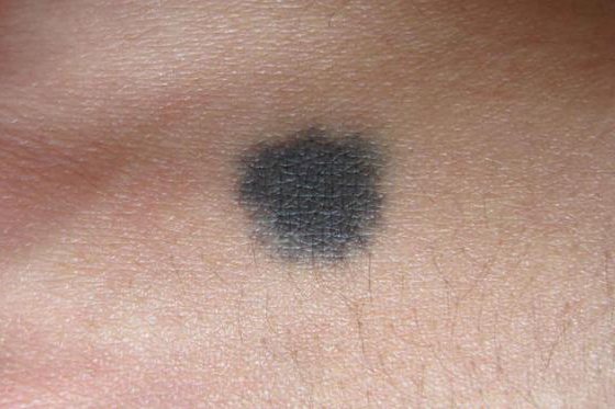 偶有炎症现象;2,蓝痣蓝痣表现为蓝色或蓝黑色的丘疹,边界清楚,好发于