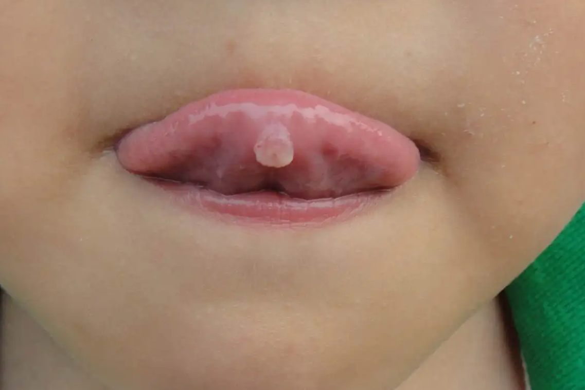 早期口腔扁平疣图片图片