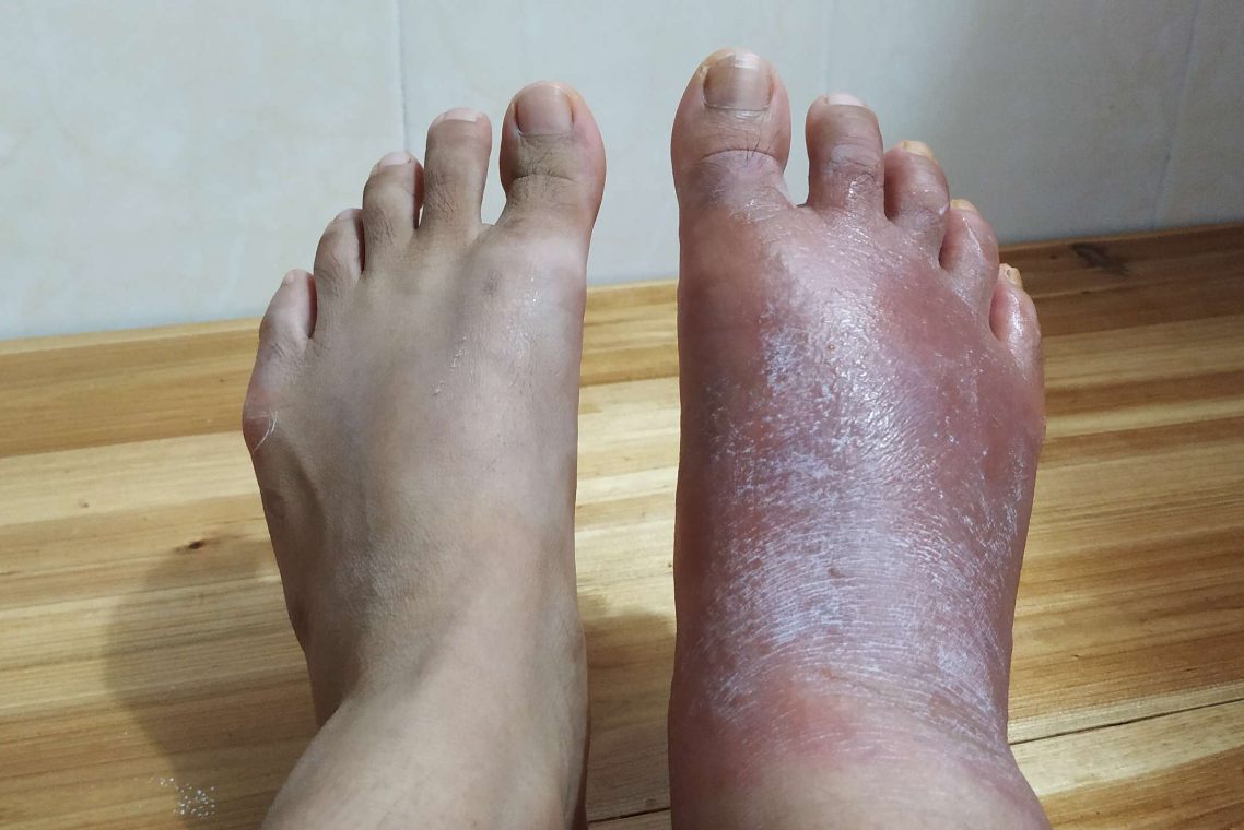 脚部过敏性皮炎
