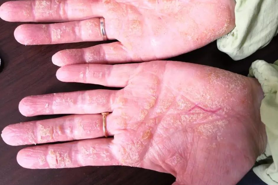 皲裂性湿疹最常发生于四肢,临床表现为皮肤干燥粗糙,纹理加深,可形成