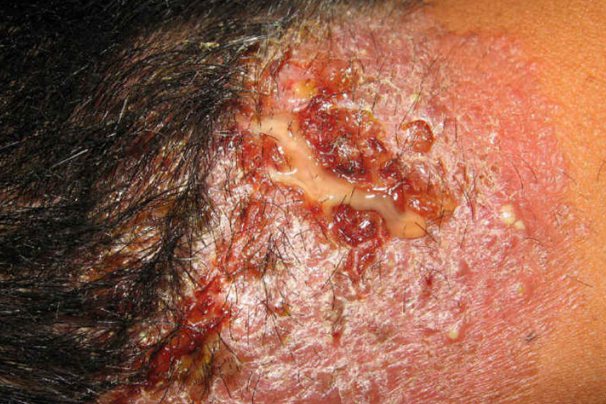 溃破期:皮肤的硬肿范围扩大,脓点增大增多,脓包破溃流脓,创口呈蜂窝状