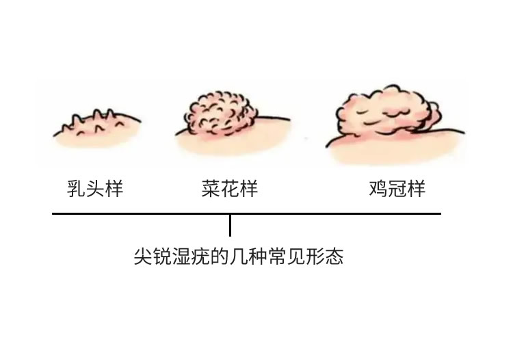 丘疹是什么样子尖锐图片