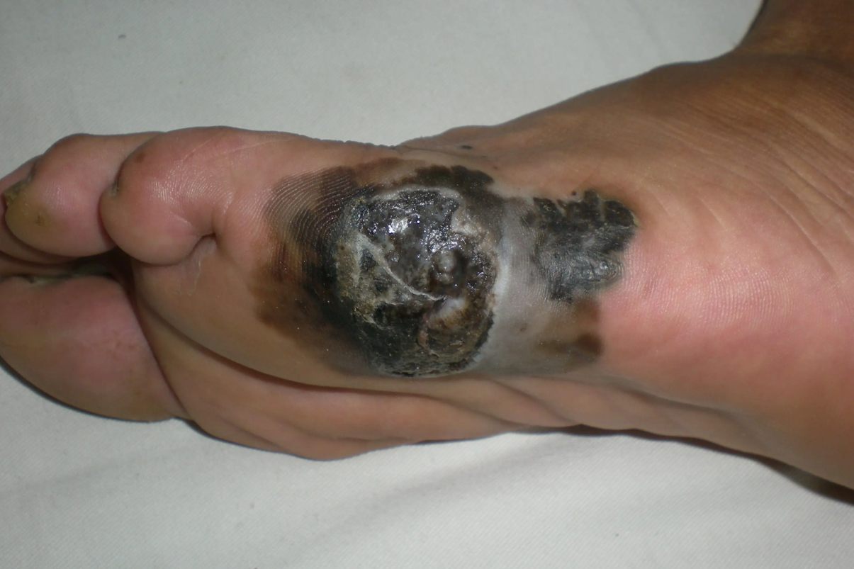 脚底黑色素瘤早期图片