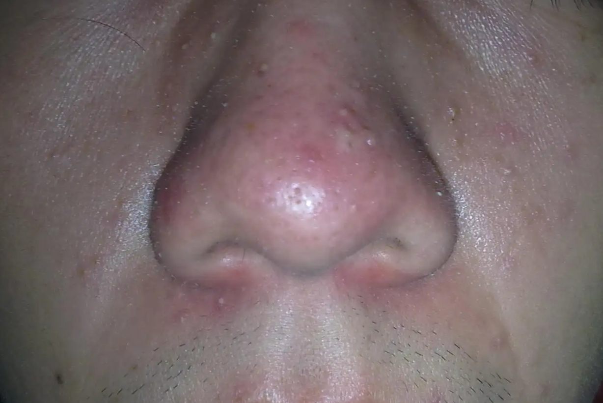 鼻头长螨虫的症状图片图片