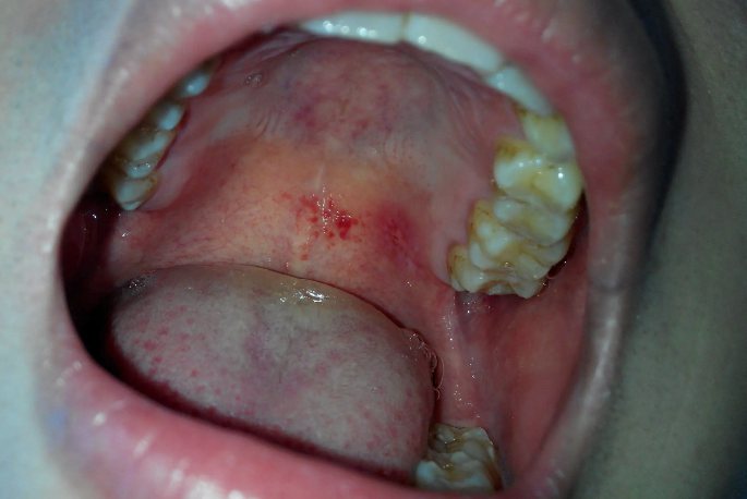 口腔癌图片 早期图片