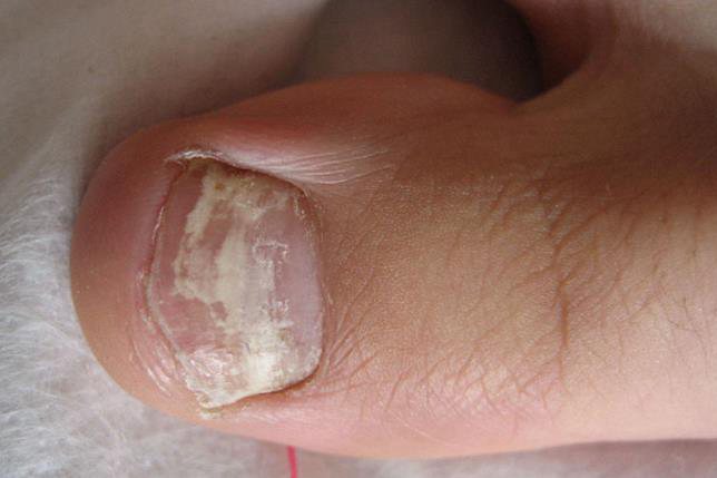 灰指甲有什么症状图片