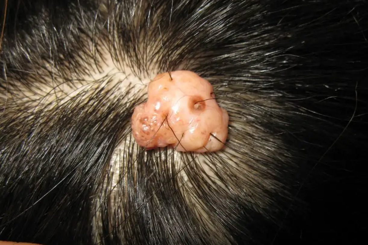头皮神经纤维瘤图片
